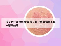 孩子为什么得银屑病 孩子得了银屑病是不是一辈子的事