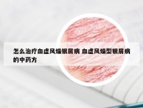 怎么治疗血虚风燥银屑病 血虚风燥型银屑病的中药方