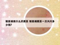 银屑病用什么药熏蒸 银屑病熏蒸一次大约多少钱?