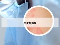 牛皮癣狐臭