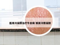 医用冷凝胶治疗牛皮癣 银屑冷敷凝胶