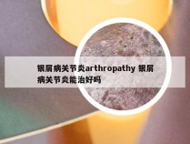 银屑病关节炎arthropathy 银屑病关节炎能治好吗