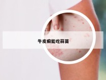 牛皮癣能吃蒜苗