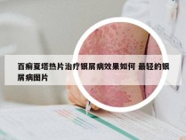 百癣夏塔热片治疗银屑病效果如何 最轻的银屑病图片