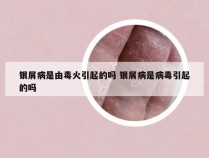 银屑病是由毒火引起的吗 银屑病是病毒引起的吗