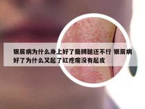 银屑病为什么身上好了胳膊腿还不行 银屑病好了为什么又起了红疙瘩没有起皮