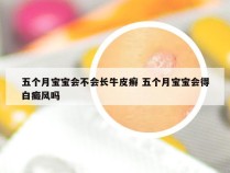 五个月宝宝会不会长牛皮癣 五个月宝宝会得白癜风吗