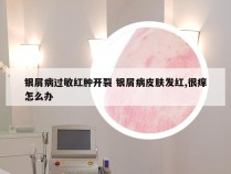 银屑病过敏红肿开裂 银屑病皮肤发红,很痒怎么办