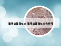 银屑病涂萌尔夫 银屑病涂萌尔夫有用吗