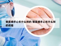 银屑病手心长什么样的 银屑病手心长什么样的疙瘩