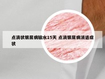 点滴状银屑病输水15天 点滴银屑病消退症状