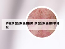 严重脓包型银屑病图片 脓包型银屑病好转特征