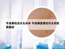 牛皮癣吃点什么补补 牛皮癣患者吃什么对皮肤最好