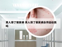 男人得了银屑病 男人得了银屑病会传染给我吗