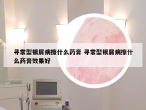 寻常型银屑病擦什么药膏 寻常型银屑病擦什么药膏效果好