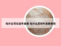吃什么可以治牛皮癣 吃什么药对牛皮癣有效