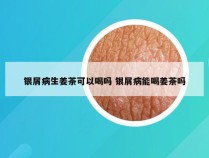 银屑病生姜茶可以喝吗 银屑病能喝姜茶吗