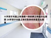 十岁孩子大腿上有像癣一样的两三块是什么原因 10岁孩子大腿上有红色条纹状是怎么回事