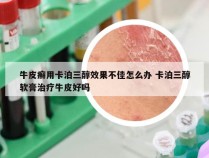 牛皮癣用卡泊三醇效果不佳怎么办 卡泊三醇软膏治疗牛皮好吗