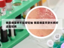 银屑病夏季不能穿短袖 银屑病夏天穿长裤好还是短裤
