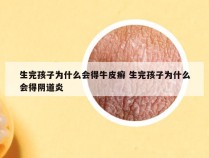 生完孩子为什么会得牛皮癣 生完孩子为什么会得阴道炎
