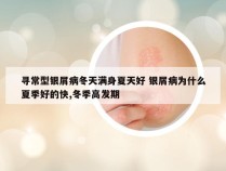 寻常型银屑病冬天满身夏天好 银屑病为什么夏季好的快,冬季高发期