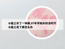 小腿上长了一块癣,07年开始长的当时只 小腿上出了癣怎么办