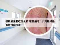 银屑病主要吃什么药 银屑病吃什么药最好最有效没副作用