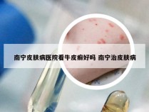 南宁皮肤病医院看牛皮癣好吗 南宁治皮肤病