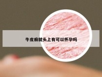 牛皮癣就头上有可以怀孕吗