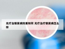 光疗治银屑病效果如何 光疗治疗银屑病怎么样
