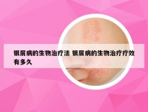 银屑病的生物治疗法 银屑病的生物治疗疗效有多久