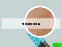 牛皮癣到哪里看