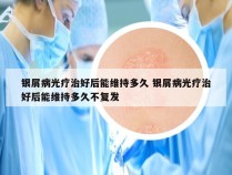 银屑病光疗治好后能维持多久 银屑病光疗治好后能维持多久不复发