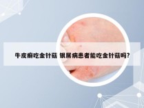 牛皮癣吃金针菇 银屑病患者能吃金针菇吗?