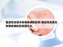脂溢性皮肤炎和银屑病的区别 脂溢性皮肤炎和银屑病的区别是什么
