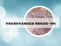 外阴白斑和牛皮癣的区别 阴癣和白斑一样吗