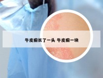牛皮癣长了一头 牛皮癣一块