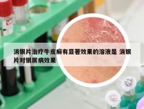 消银片治疗牛皮癣有显著效果的溶液是 消银片对银屑病效果