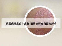 银屑病样皮炎牛皮鲜 银屑病样皮炎能治好吗