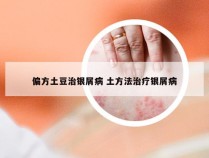 偏方土豆治银屑病 土方法治疗银屑病