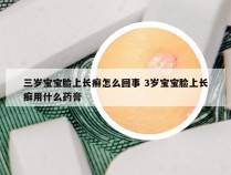三岁宝宝脸上长癣怎么回事 3岁宝宝脸上长癣用什么药膏