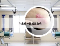 牛皮癣一抓就出血吗