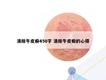 清除牛皮癣450字 清除牛皮癣的心得