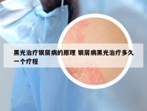 黑光治疗银屑病的原理 银屑病黑光治疗多久一个疗程