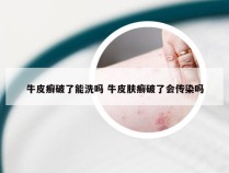 牛皮癣破了能洗吗 牛皮肤癣破了会传染吗