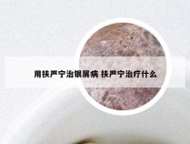 用扶严宁治银屑病 扶严宁治疗什么