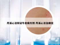 丹溪心法辩证牛皮癣方剂 丹溪心法治癫狂
