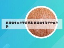银屑病多大年零容易出 银屑病多发于什么年龄