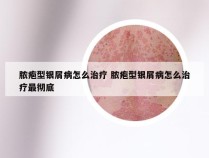 脓疱型银屑病怎么治疗 脓疱型银屑病怎么治疗最彻底